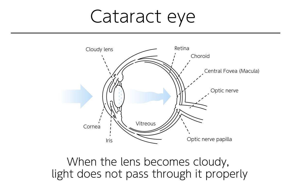 Diagram of an eye with a cataract: a cloudy lens scatters incoming light
