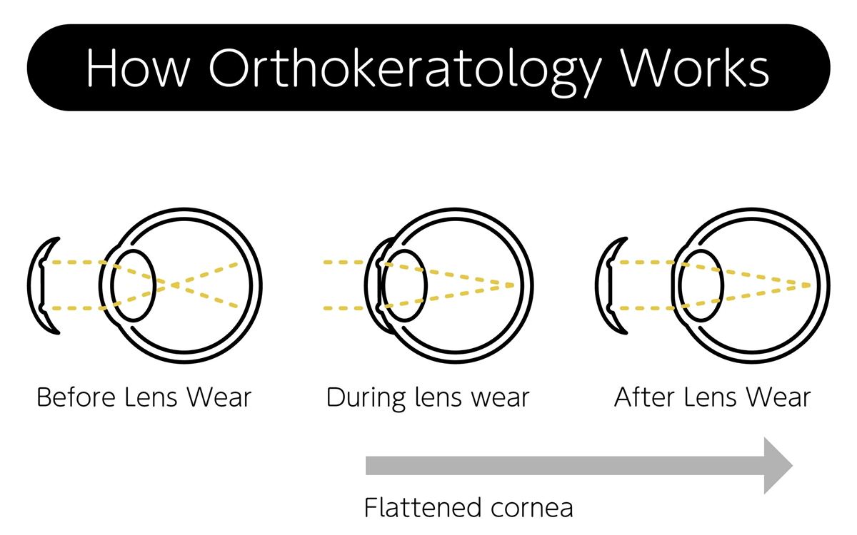 Diagram: how orthokeratology works — before, during, and after lens wear