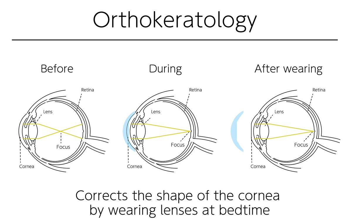 Diagram: orthokeratology corrects the shape of the cornea during overnight wear