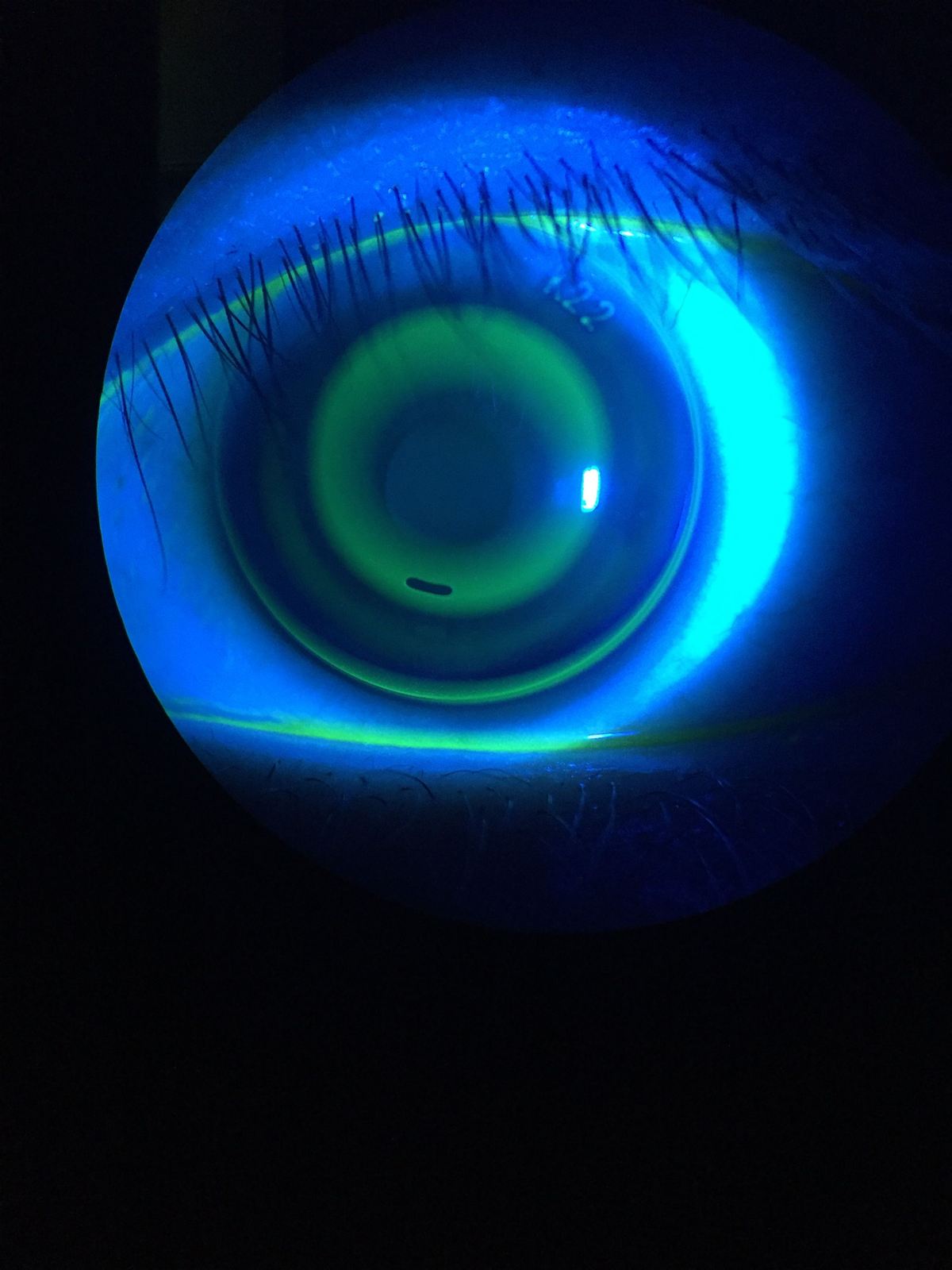 Slit-lamp view of an orthokeratology lens fit with fluorescein dye
